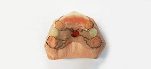 Профилактические протезы на верхнюю челюсть